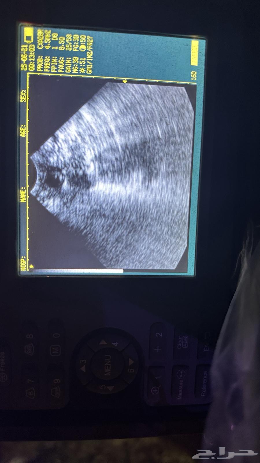Ultrasound examination in the Eastern Province by quantity636186765436181115