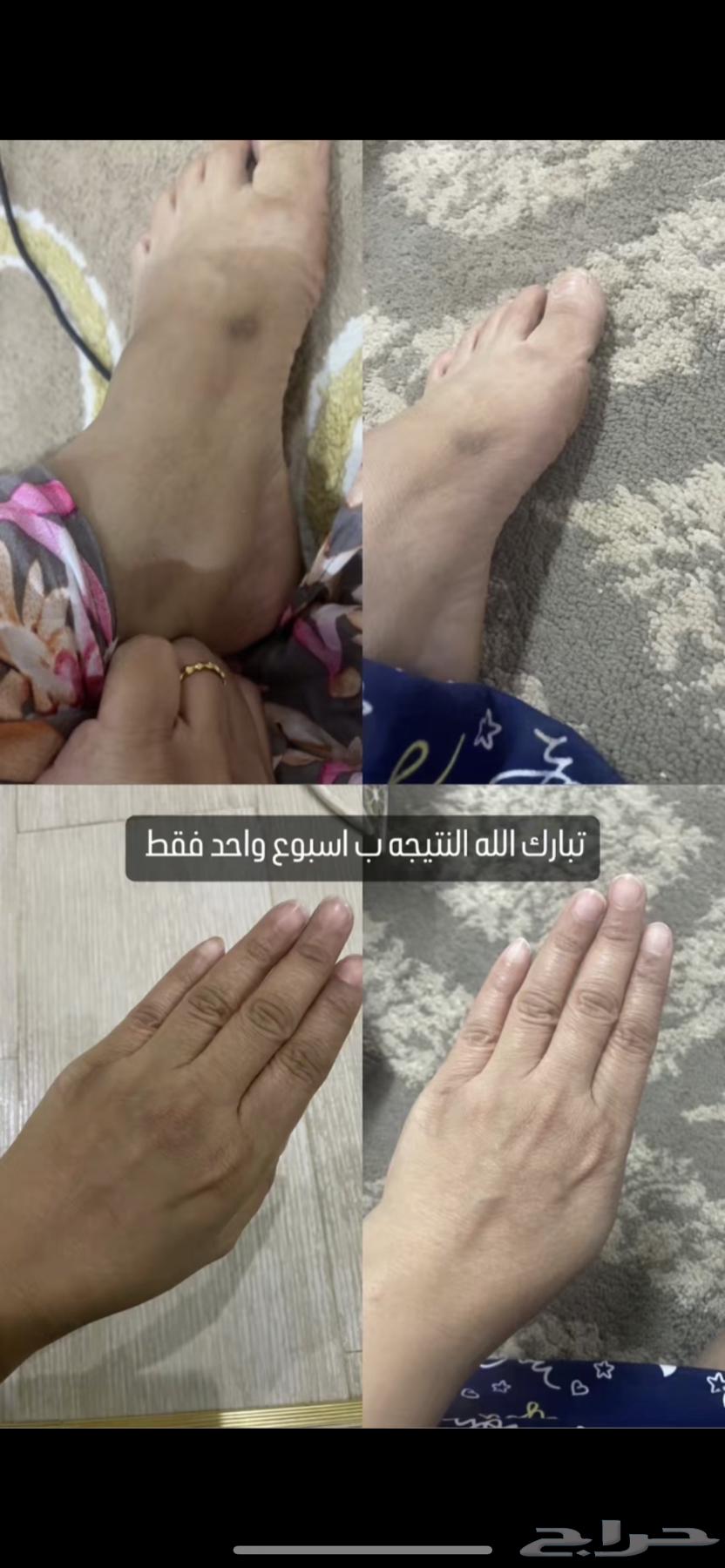 كريم تبييض البشره وازالة التصبغات64366615192067113