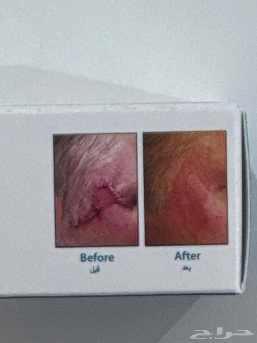 مرهم ازالة الندبات والآثار64424748380418111
