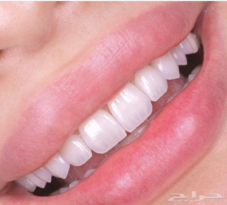 ابتسامه هوليود64443182623489113