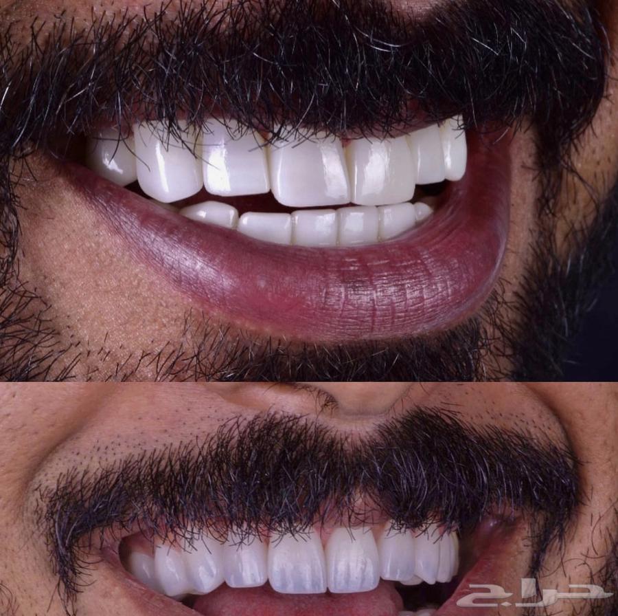 ابتسامه هوليود64443182623489111