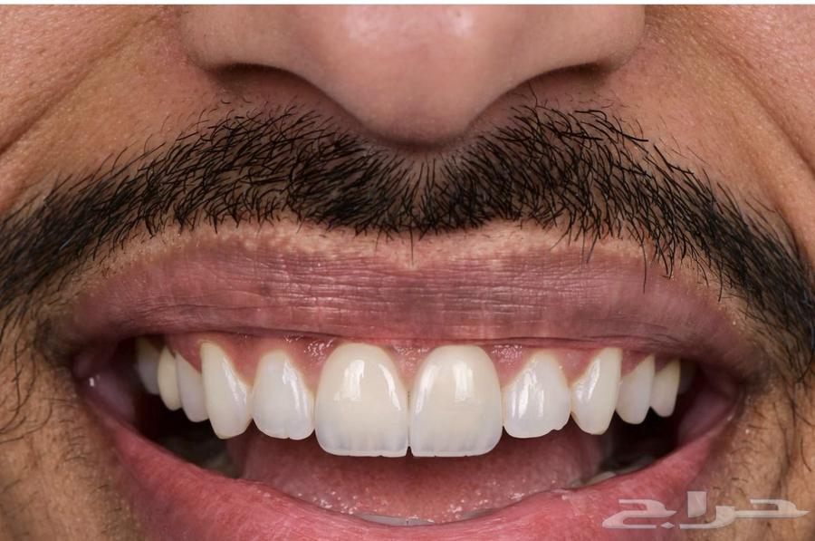 ابتسامه هوليود64443182623489110