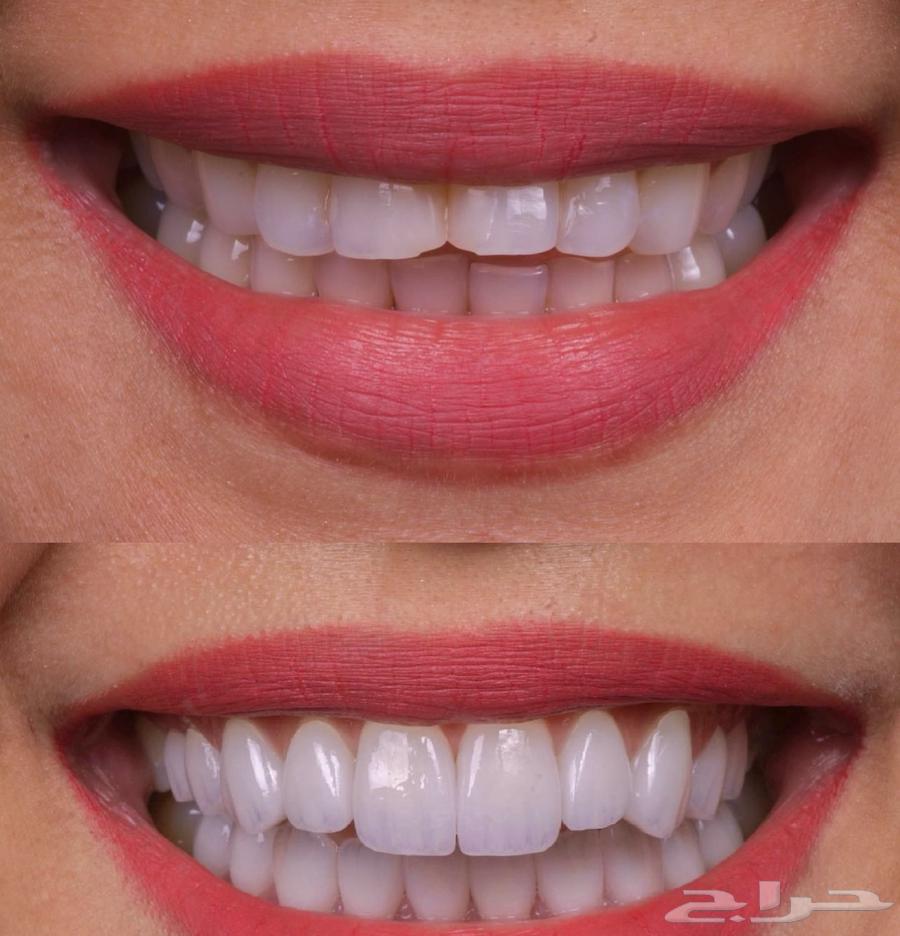 ابتسامه هوليود64443182623489114