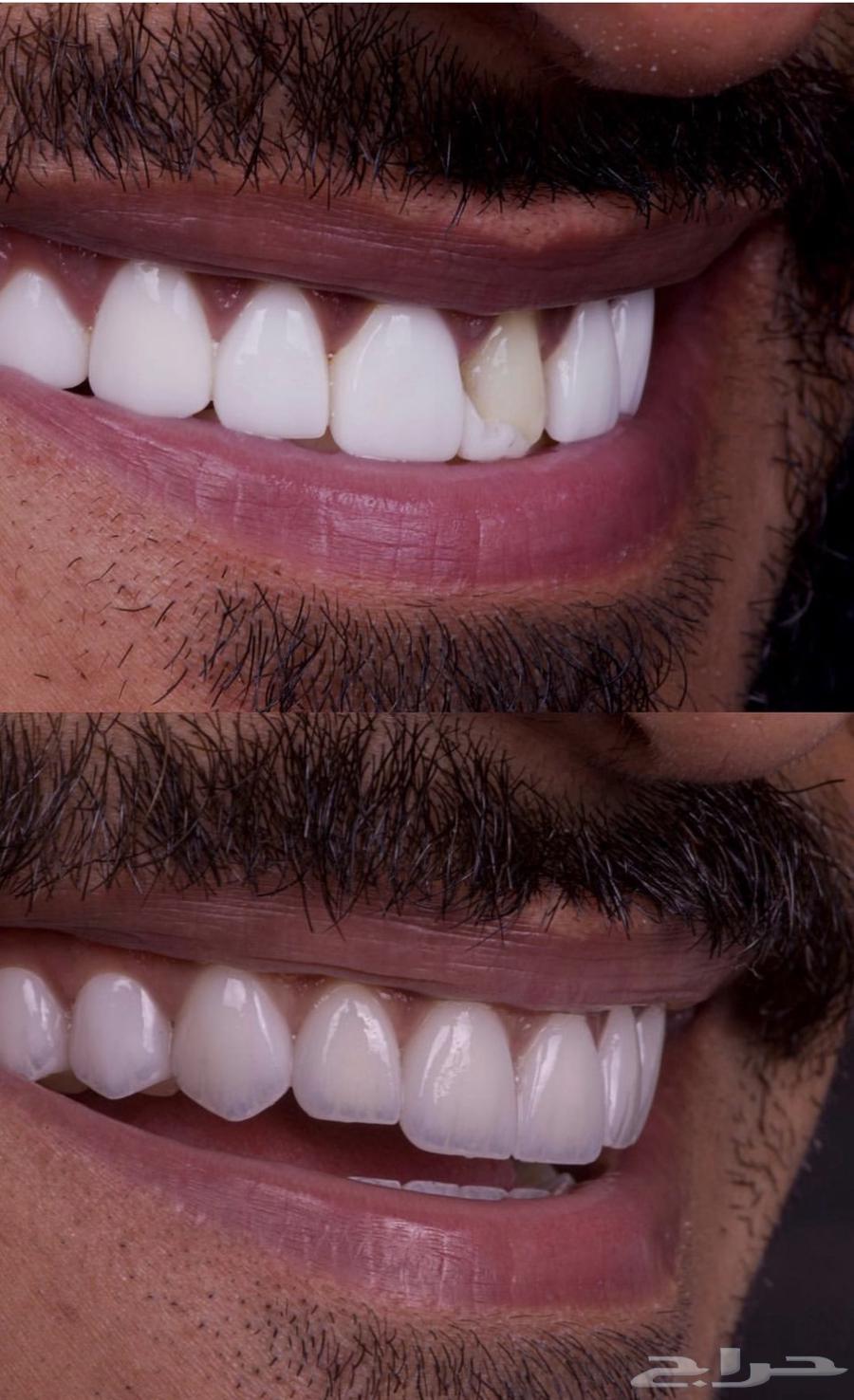 ابتسامه هوليود64443182623489112