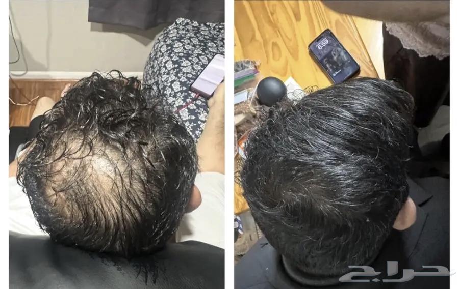 Minoxidil64519540103810113