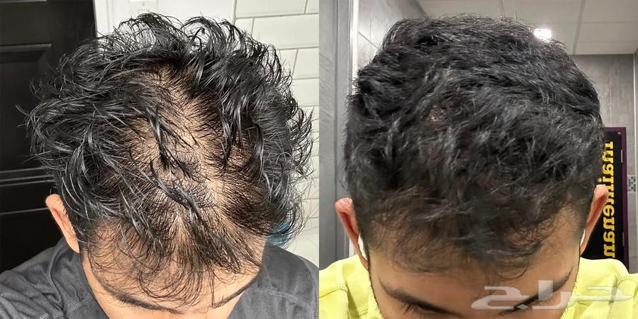 Minoxidil64519540103810111