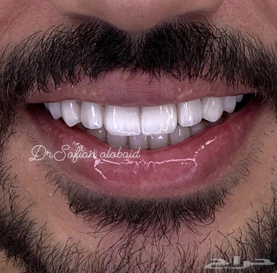 عروض ابتسامة هوليوود بمناسبة اليوم الوطني64529348523651112