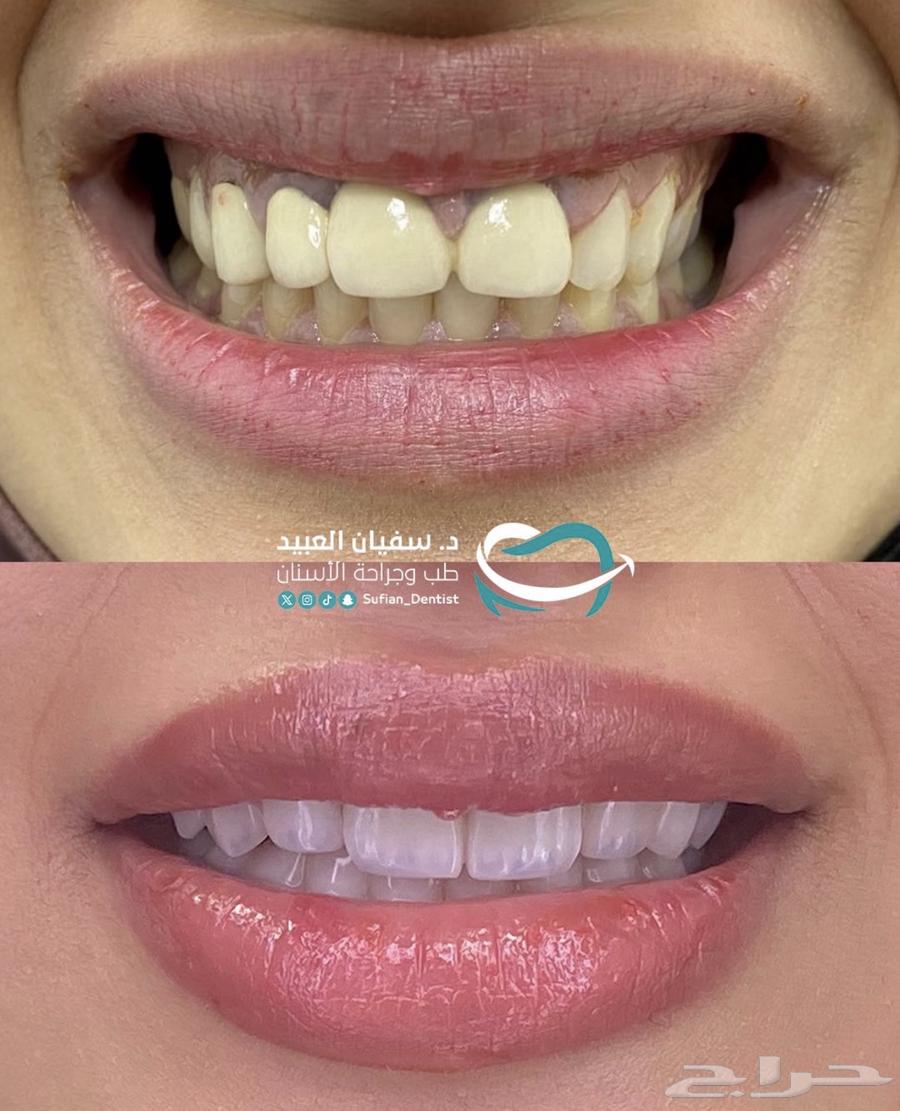 عروض ابتسامة هوليوود بمناسبة اليوم الوطني64529348523651110