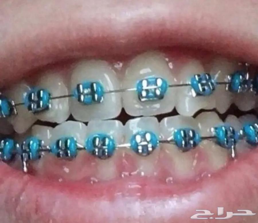 تقويم اسنان زينه عروض اليوم الوطني64575629449089112