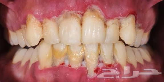 تنظيف جير للحالات الصعبه بشكل مجاني بالكامل64172900388609110