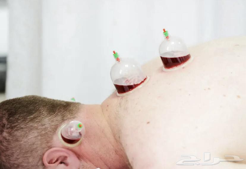 اخصائي حجامة سوداني بالرياض64227605190658114