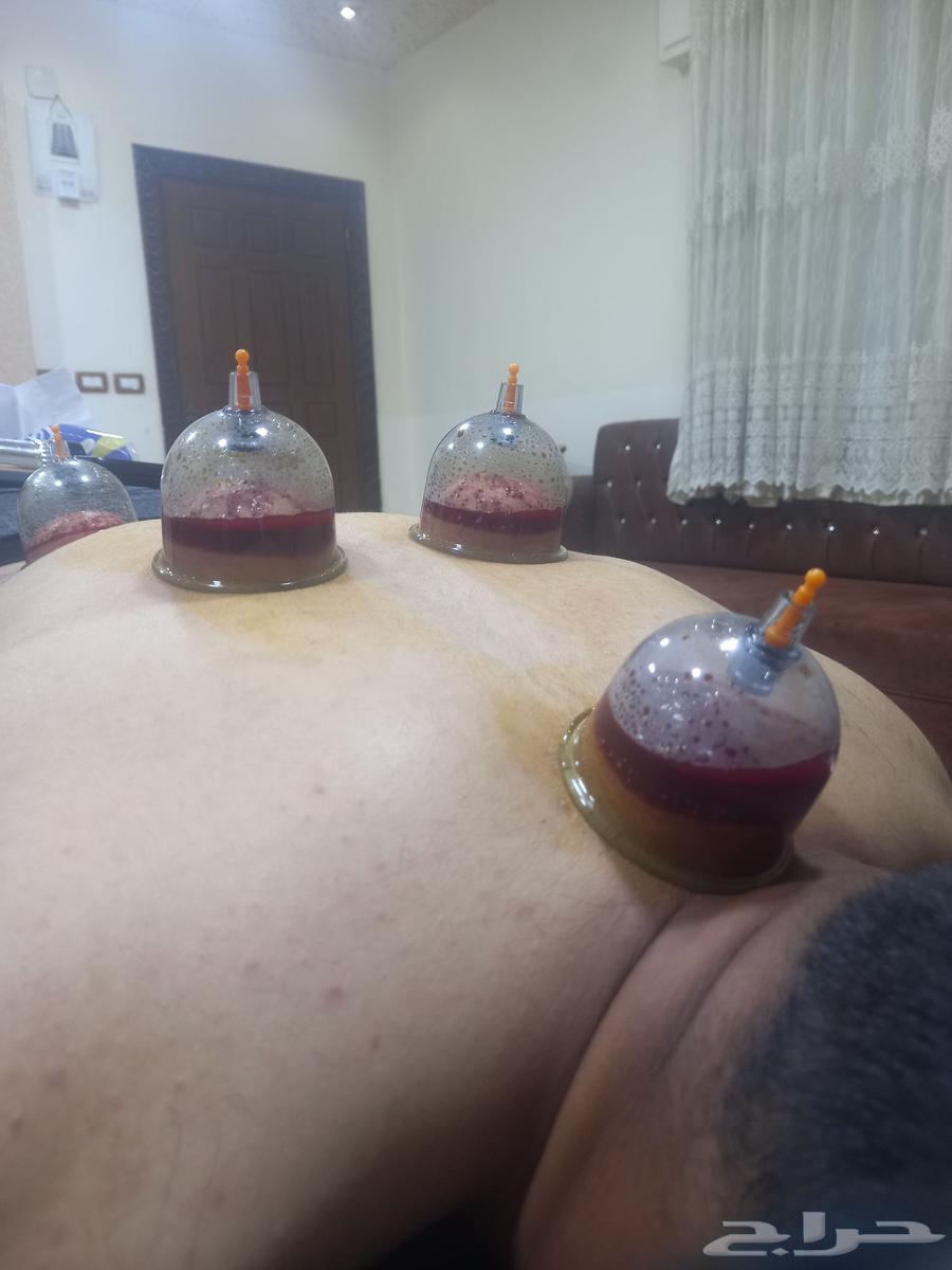 الحجامة النبوية والابر الصينية والتغذيه العلاجيه64212453136258110