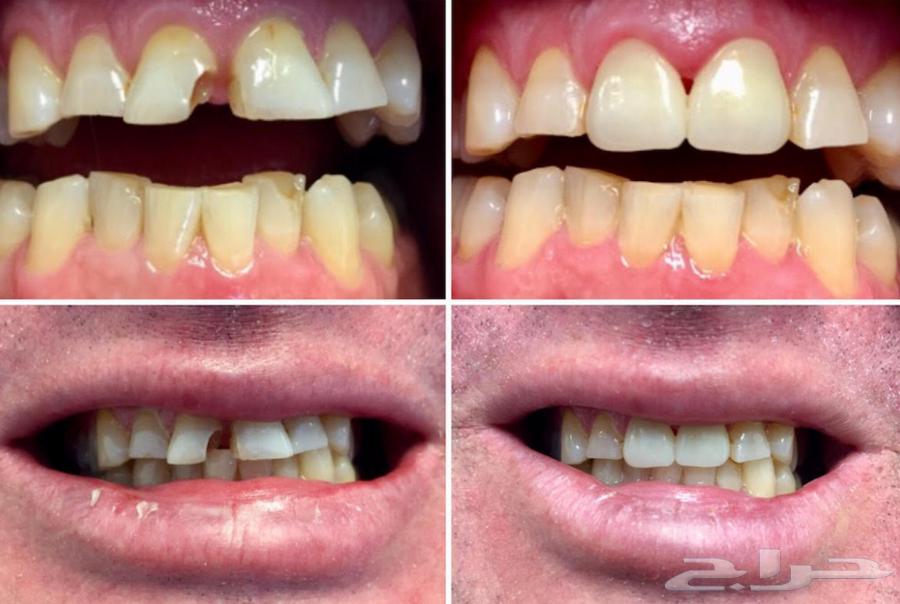 علاج أسنان مجاني للتواصل واتساب64218306828289112