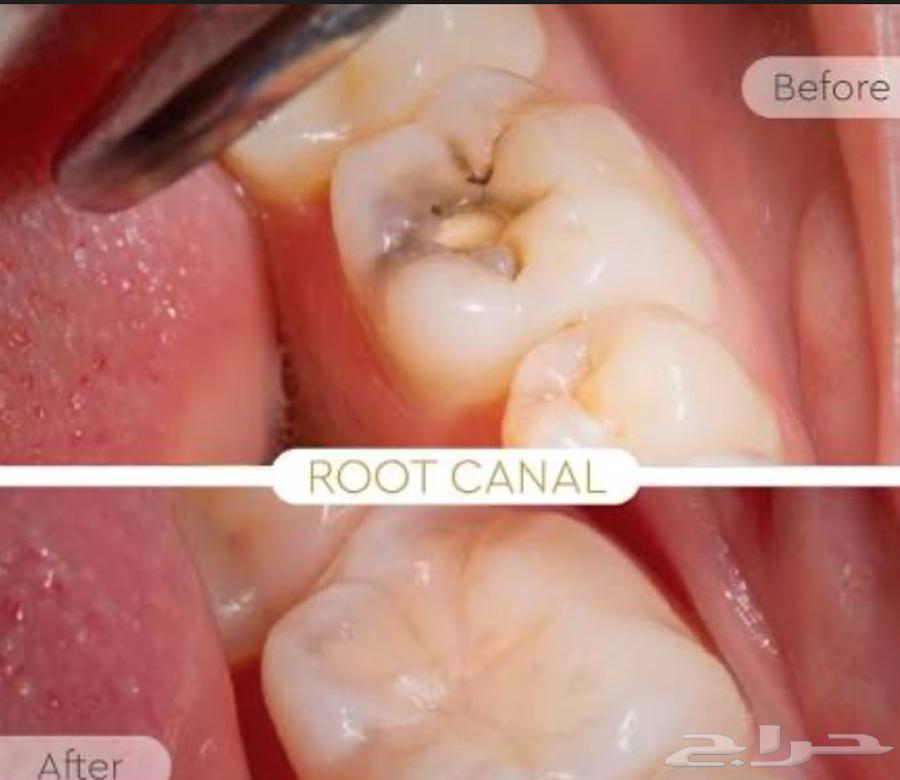 علاج أسنان مجاني للتواصل واتساب64218306828289113
