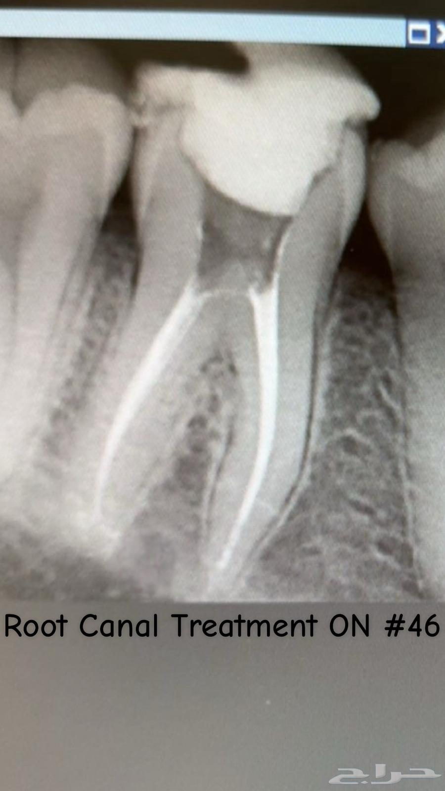 عصب الاسنان وتركيبات الاسنان64241486212098111