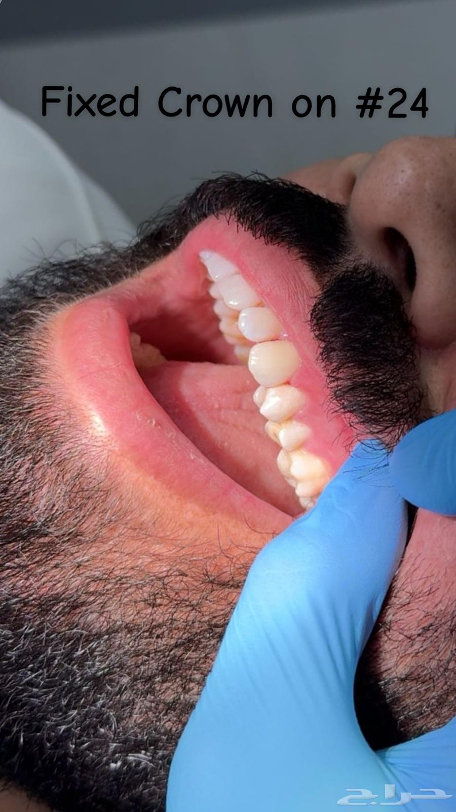 عصب الاسنان وتركيبات الاسنان64241486212098110