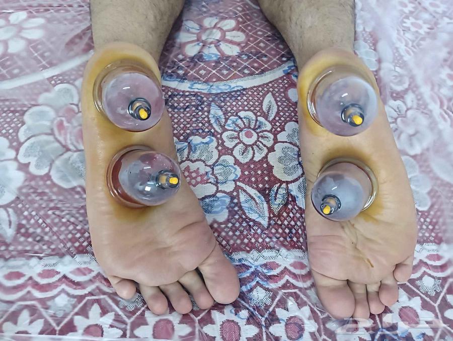 حجامة نارية وهوائية بالمدينة المنورة  خبرة 10 سنوات64249505968769113