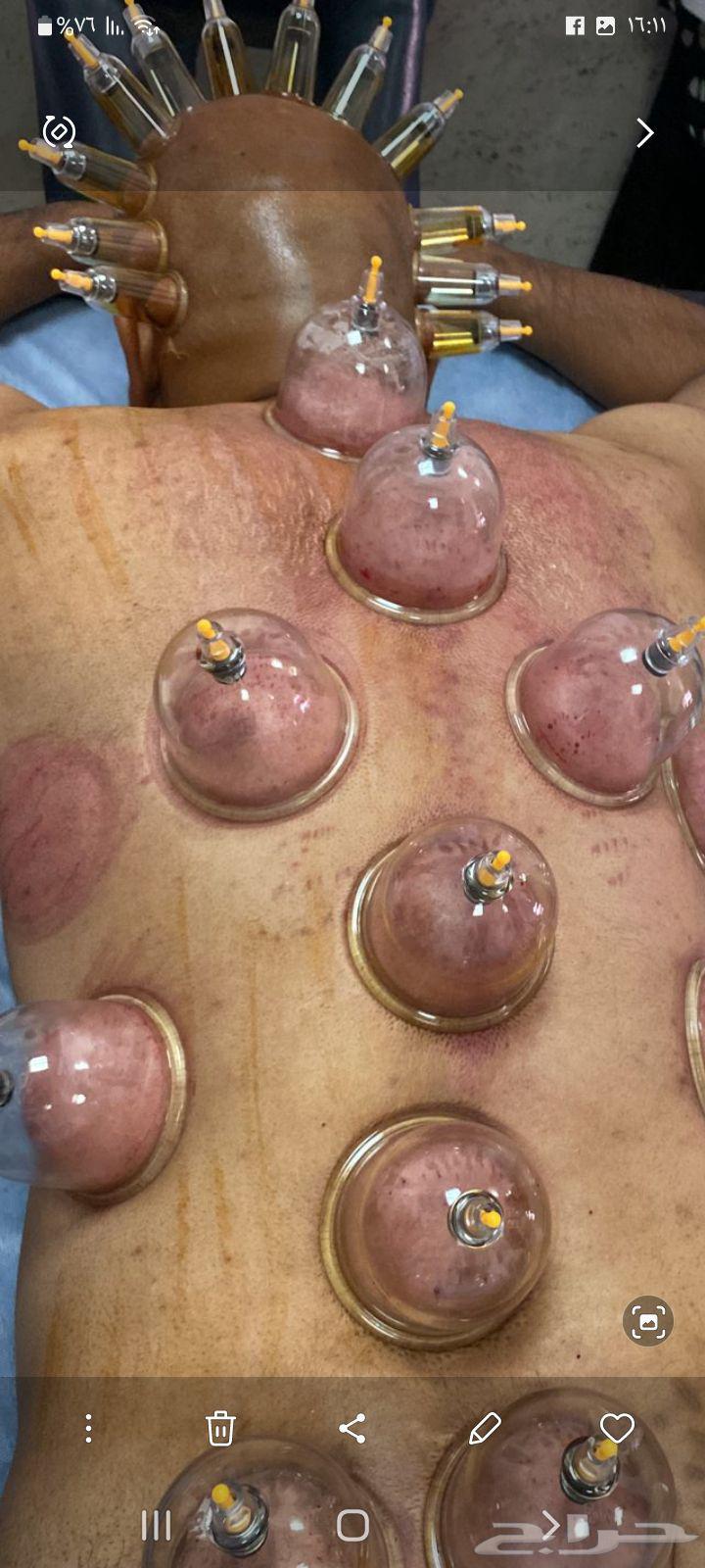 الحجامة النبوية64254824700930110