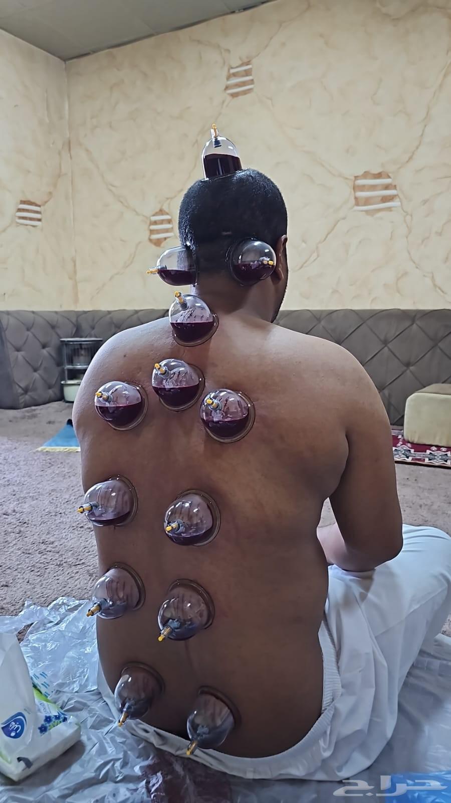 حجامة نارية وهوائية بالمدينة المنورة  خبرة 10 سنوات64249505968769111