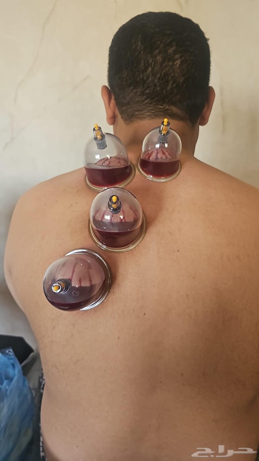 حجامة نارية وهوائية بالمدينة المنورة  خبرة 10 سنوات64249505968769110