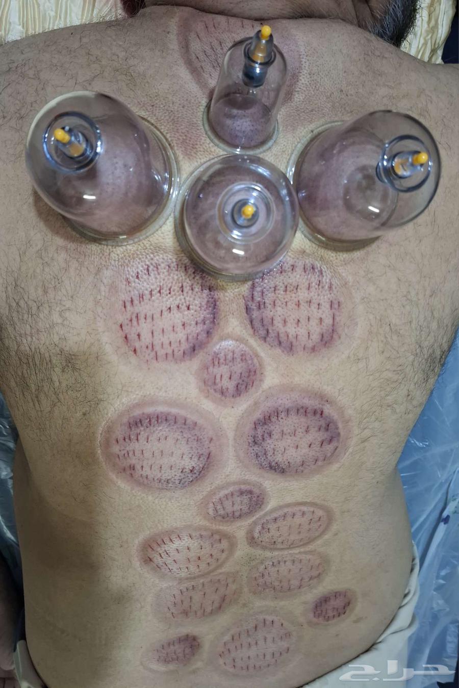 حجامة السنة النبوية بالرياض64379941157123112