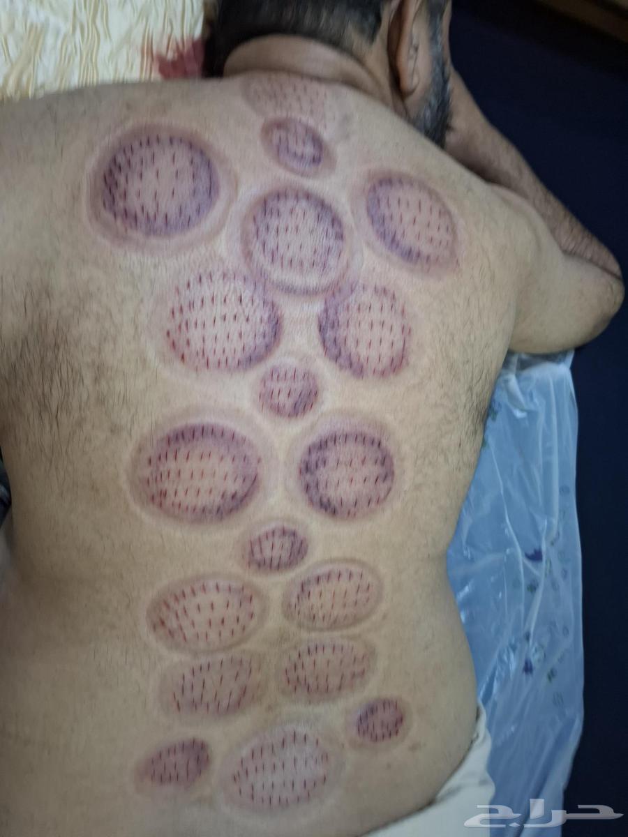 حجامة السنة النبوية بالرياض64379941157123110