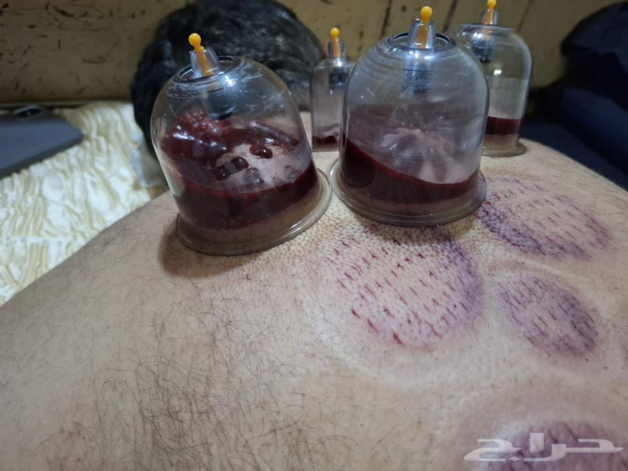 حجامة السنة النبوية بالرياض64379941157123111