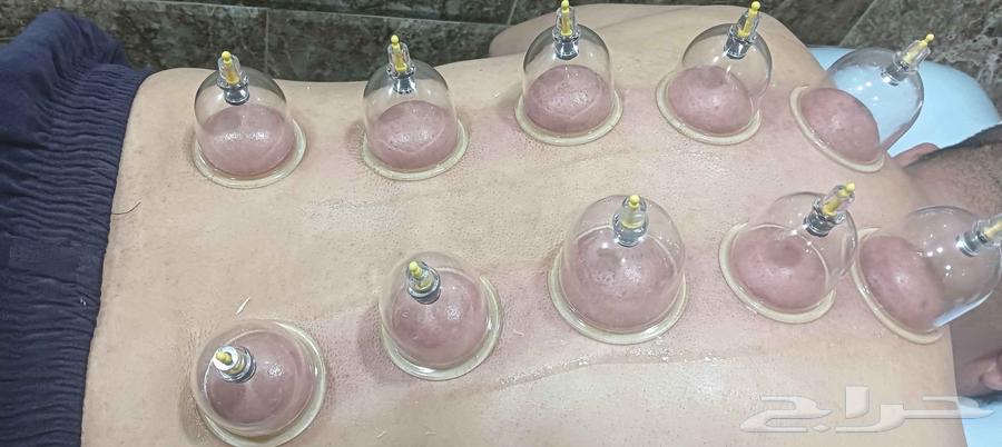 حجامة السنة النبوية بالرياض64379941157123114