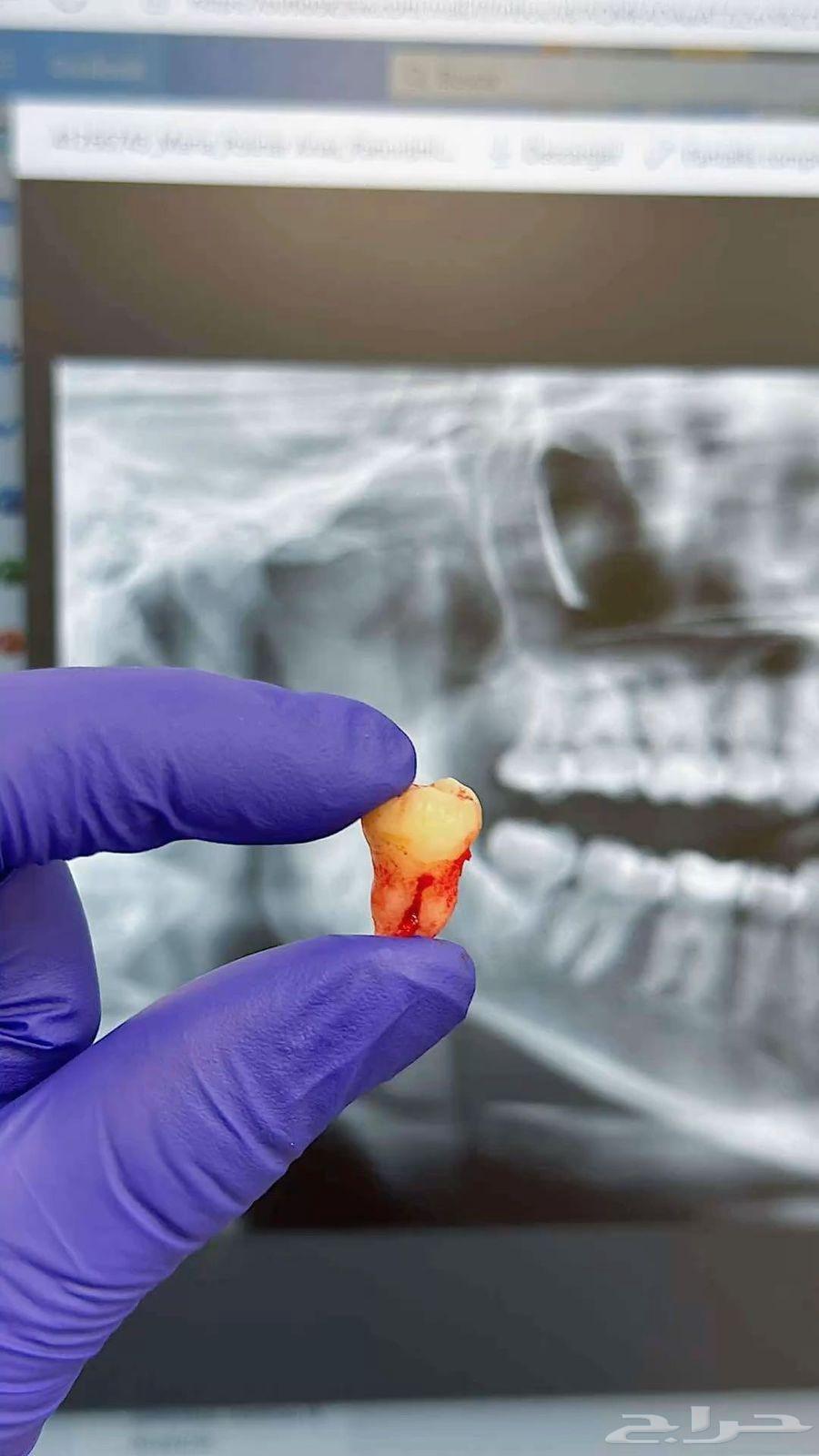 خلع اسنان مجاني شامل الاشعة والفحص64403506151939110