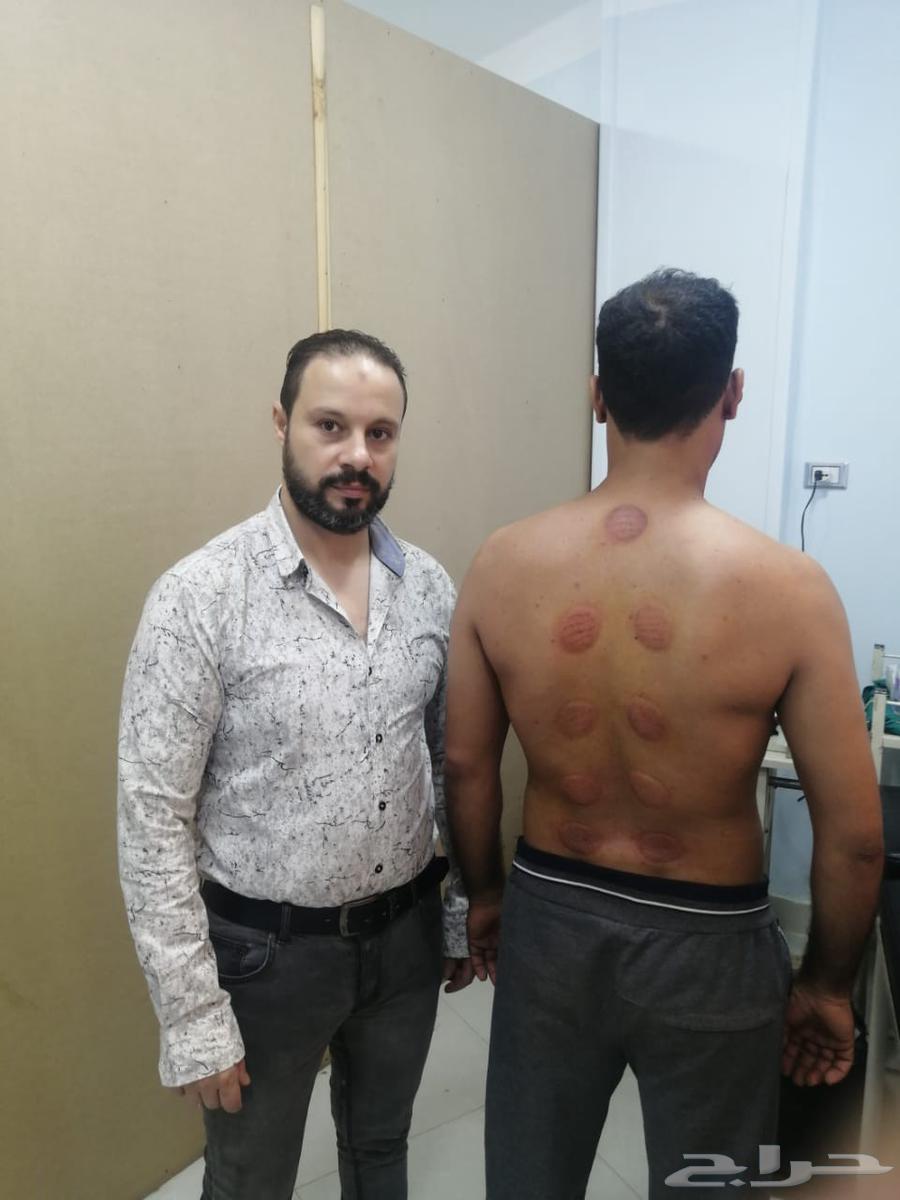اخصائي علاج طبيعي ومساج واصابات ملاعب وحجامه طبيه64572785396993110