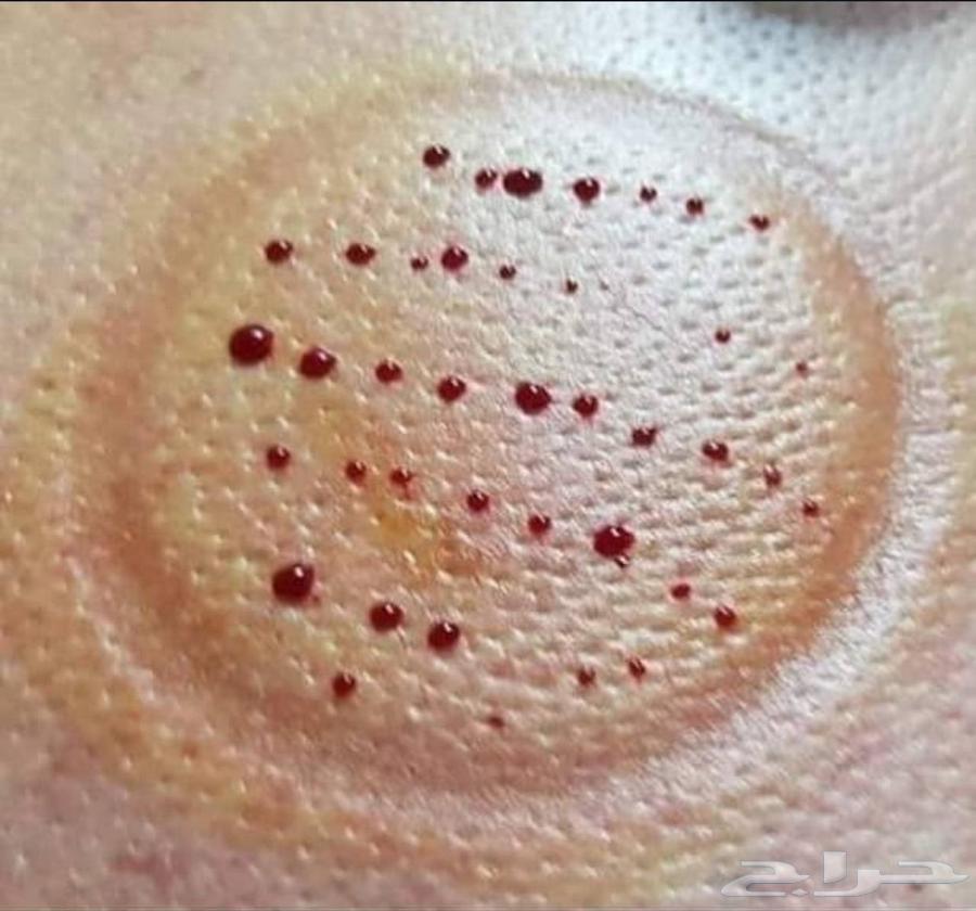 الحجامة النبوية .. الحجامة علاج طبيعي يعيد لجسمك توازنه64572917383427110