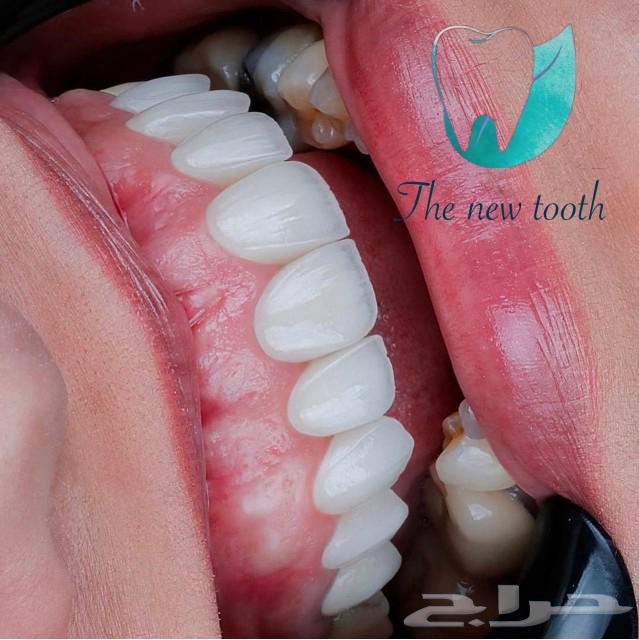 ابتسامه هوليود63189838727171114