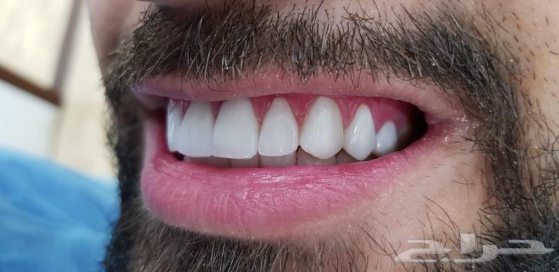 عروض حصريه وقوية ع ابتسامة هوليود63470381248259113