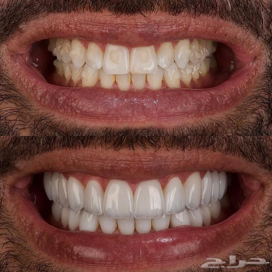 ابتسامة هوليوود ايماكس الألمانية63032728686209113