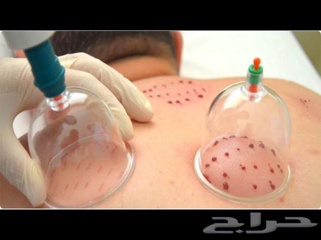 Sports and Therapeutic Massage with Cupping Therapy63611966754050114