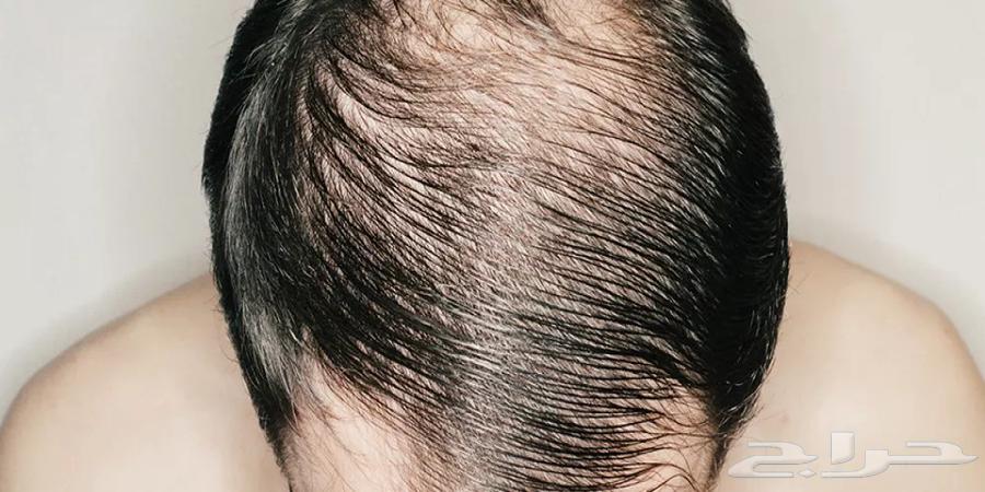 ((حبوب)) مينوكسيدل لتساقط الشعر الوراثي64478732322946110