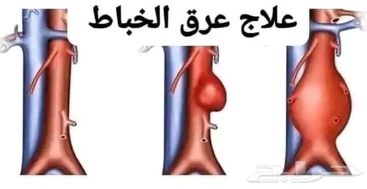 Dislocation and cupping64514210135043111