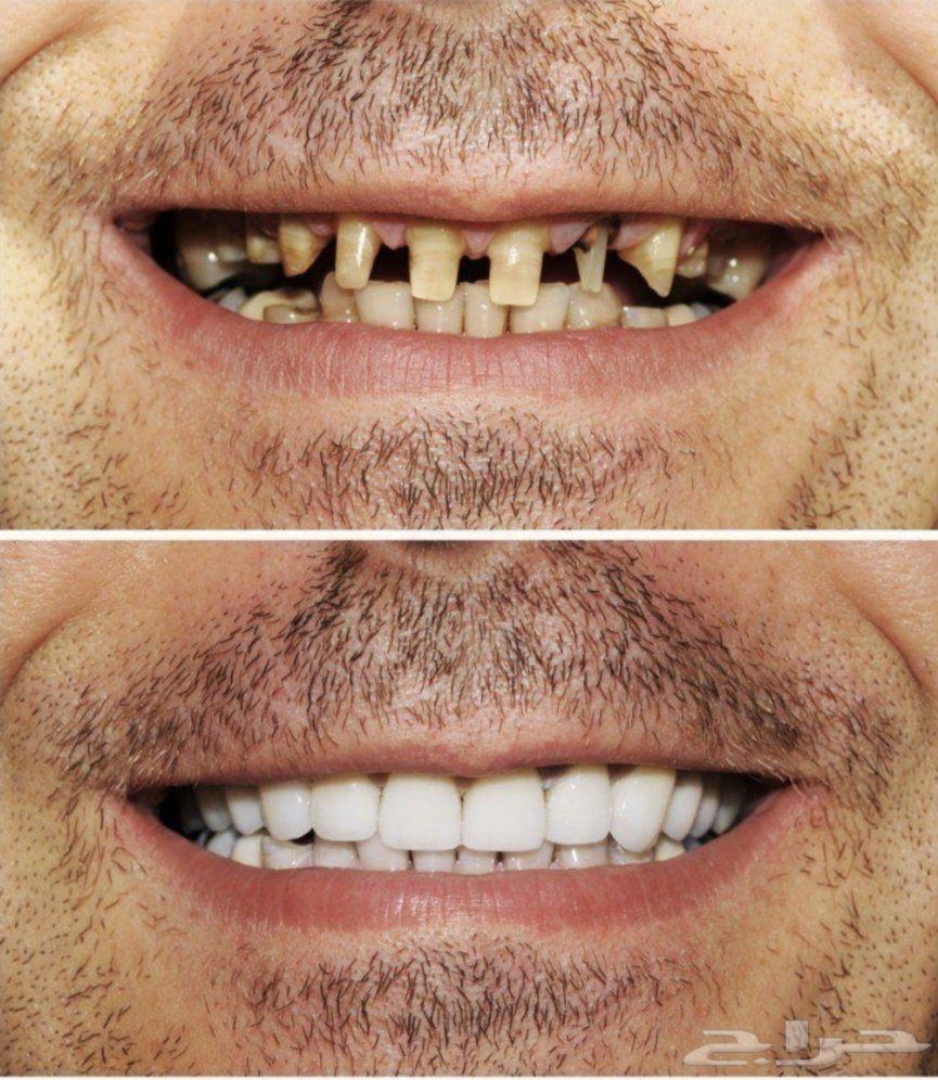 ابتسامة فاخرة... عروض خاصة64570764460675111