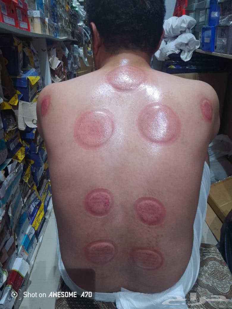 الحجامة النبويه وطق الابهر64589339793665110